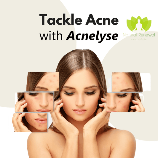 tackle acne with acnelyse